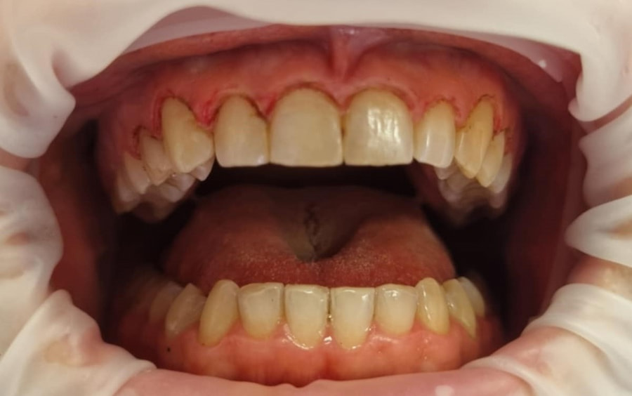 Zabieg gingiwektomi po