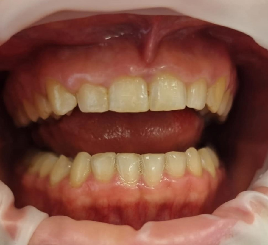 Zabieg gingiwektomi przed