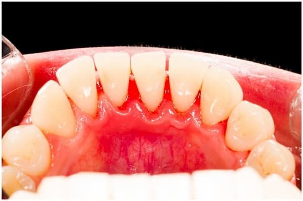 Zęby przed skalingiem