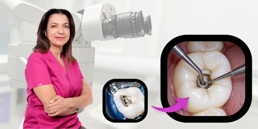 Leczenie kanałowe Leczenie kanałowe